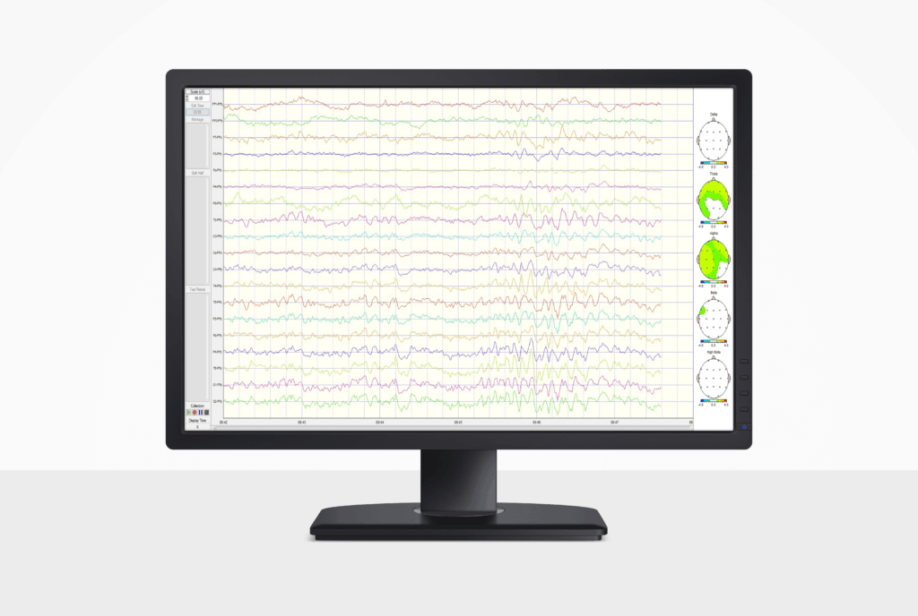 EEG Tracings in Neuroguide