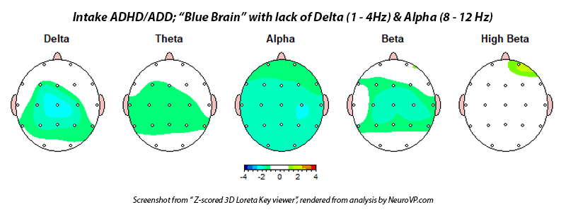 Neurofeedback ADHD ADD Blue Brain