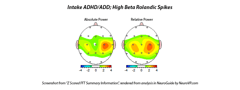 Neurofeedback ADD ADHD TDA TDAH Rolandic Spikes